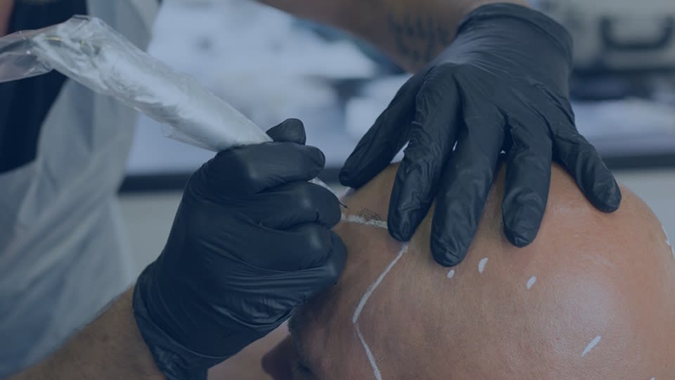 FTG Fusion Scalp Micropigmentation SMP